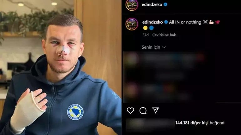 Edin Dzeko'dan Korkutan Sakatlık!